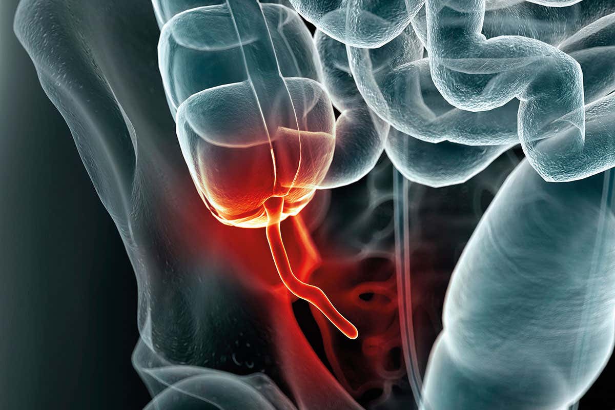 Graphic of inflamed appendix