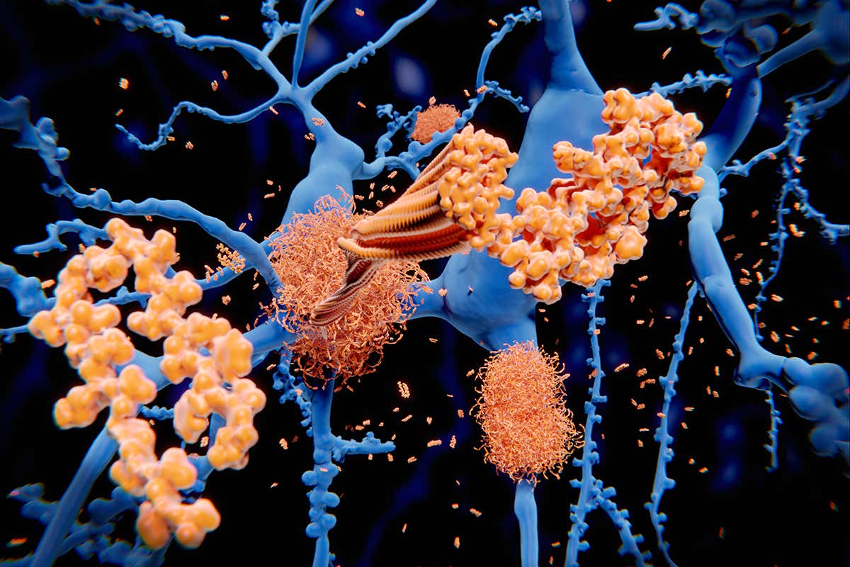 Amyloid protein in Alzheimer's disease.