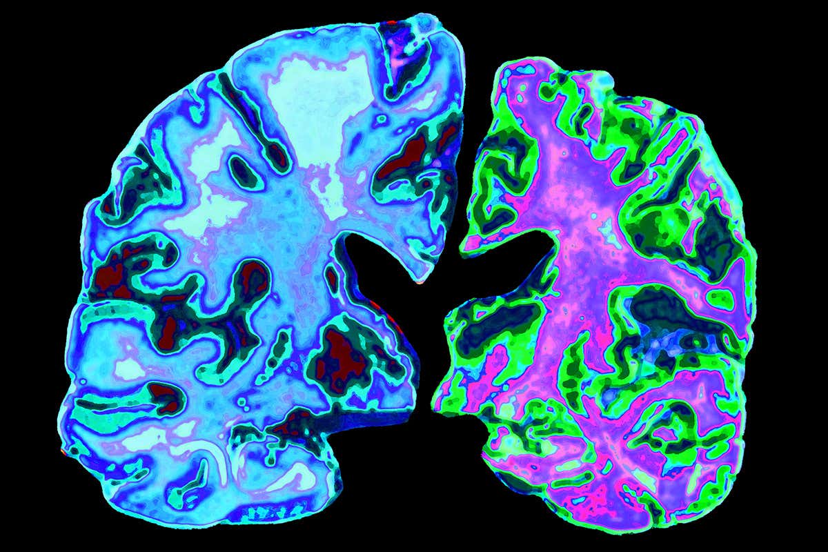 Alzheimer’s leads to the loss of brain matter (right)