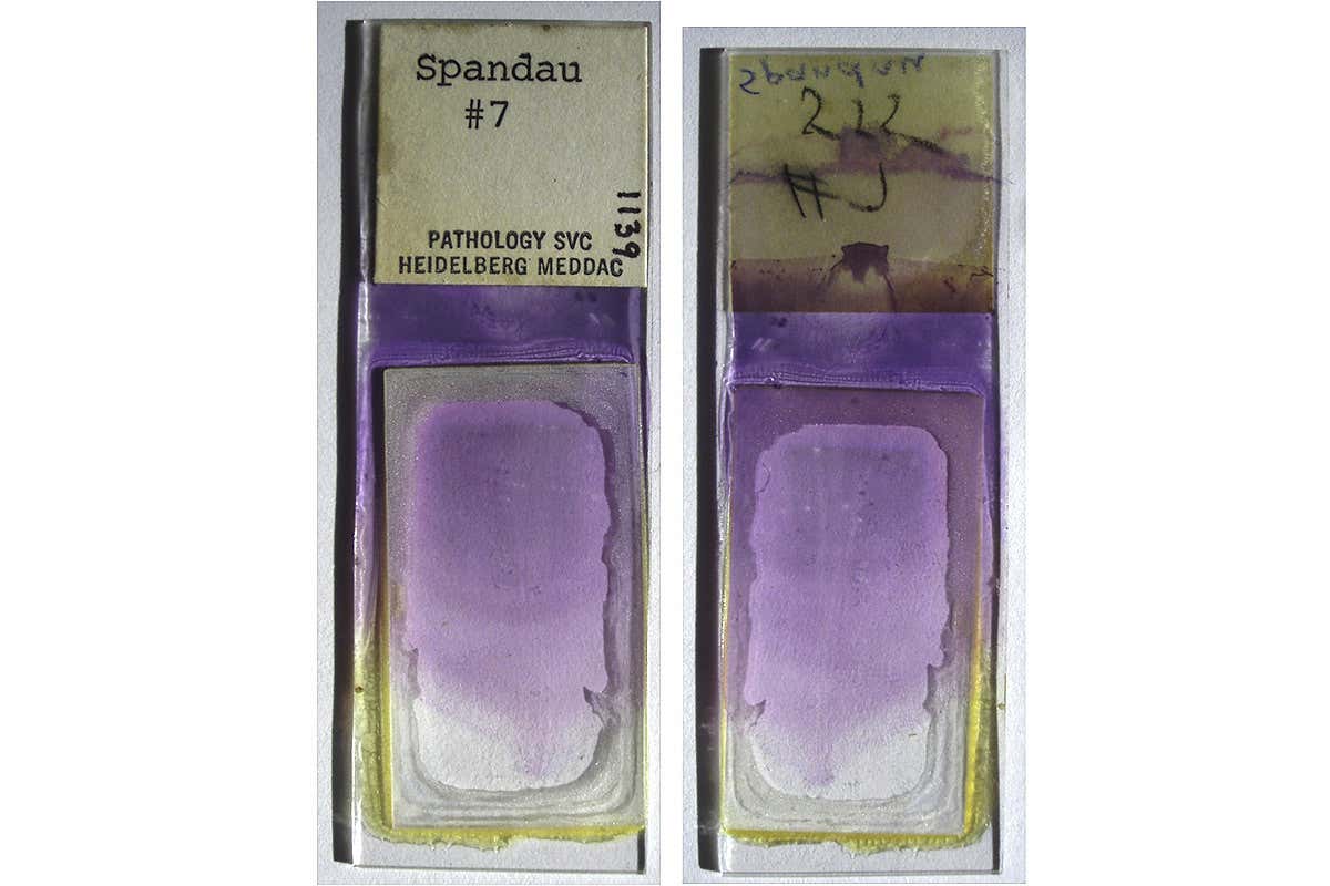 The front and back of the blood sample, labelled “Spandau #7 PATHOLOGY SVC HEIDELBERG MEDDAC 1139”