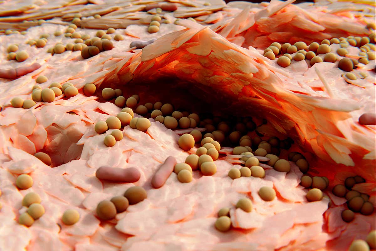 Staphylococcus aureus bacteria populate the cracked skin