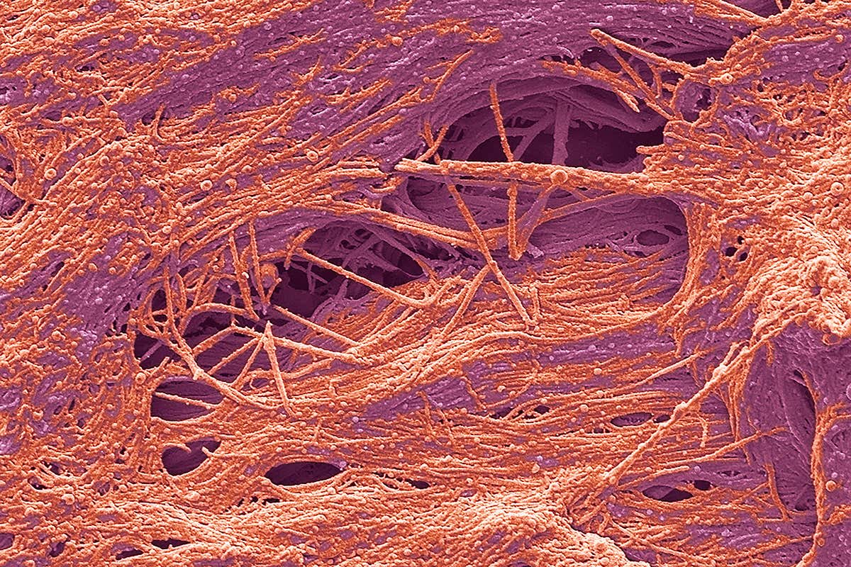 Amyloidosis involves the build-up of sticky protein
