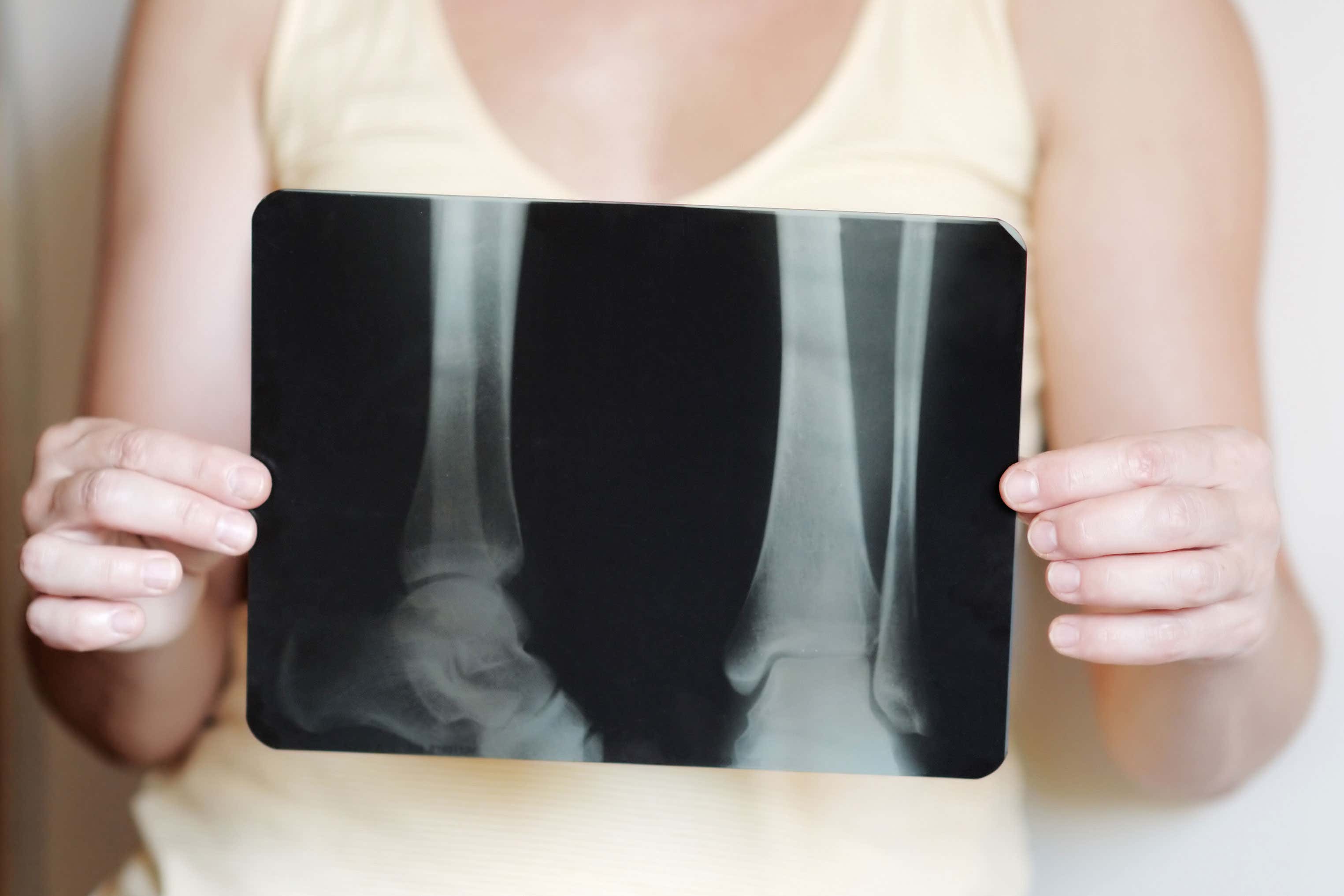Women have a higher risk of bone fracture after menopause