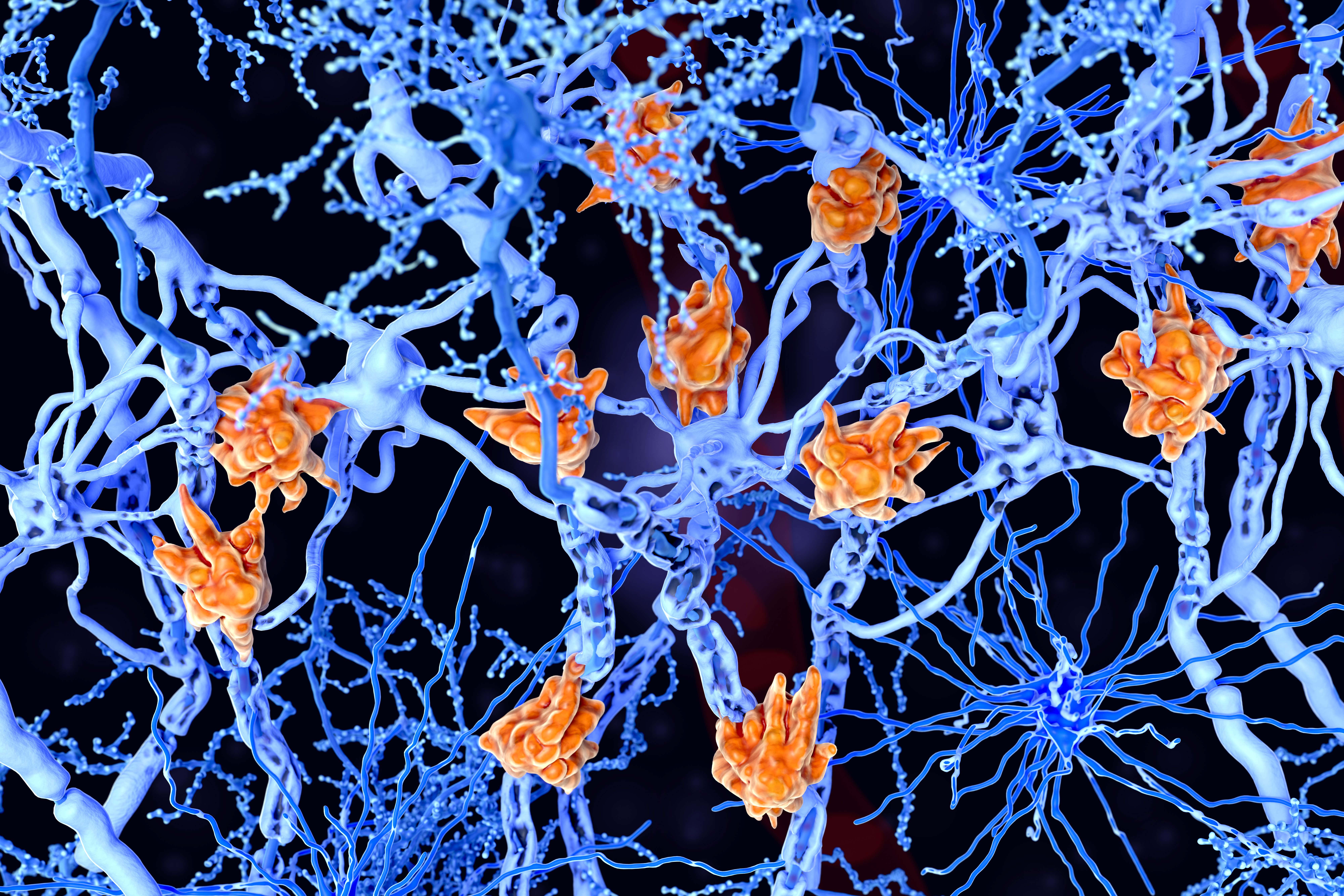 The insulating covers of nerve cells are damaged in multiple sclerosis