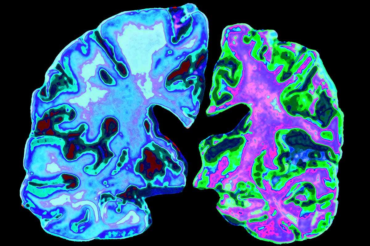 Alzheimer's disease causes damaged to the brain