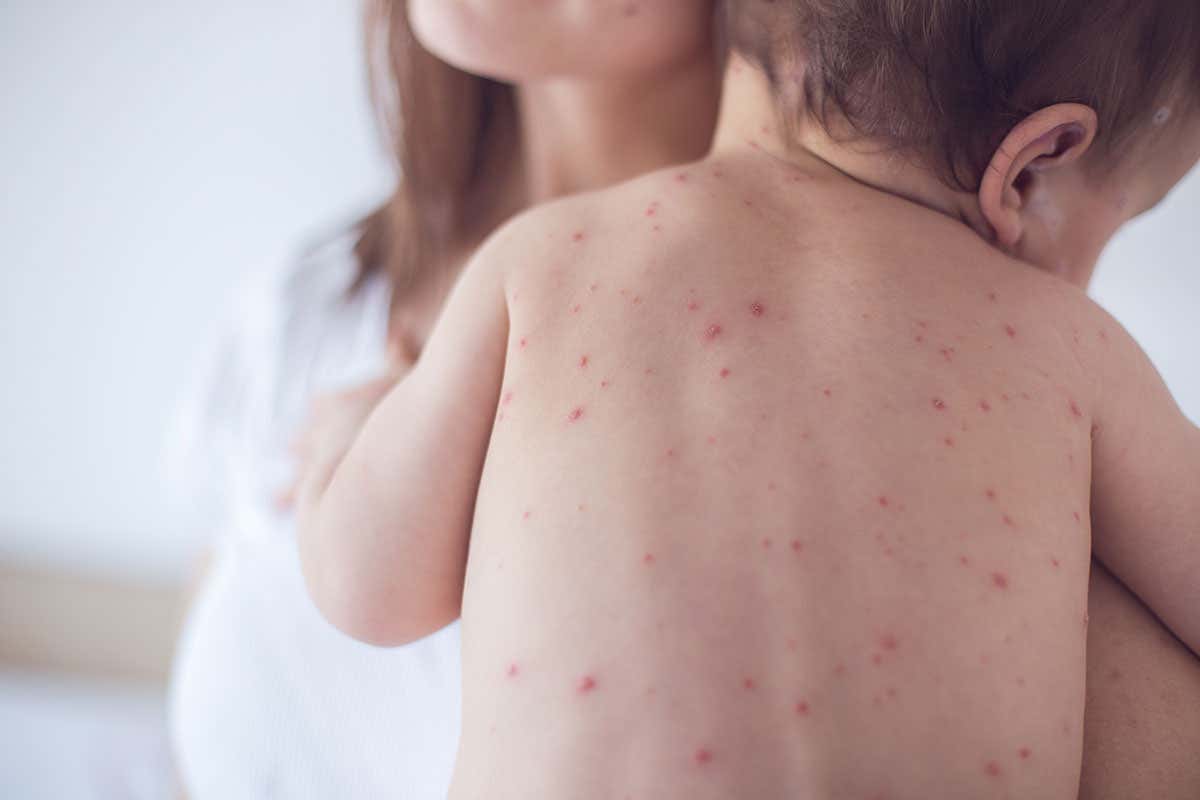 Child with Measles rash on their back