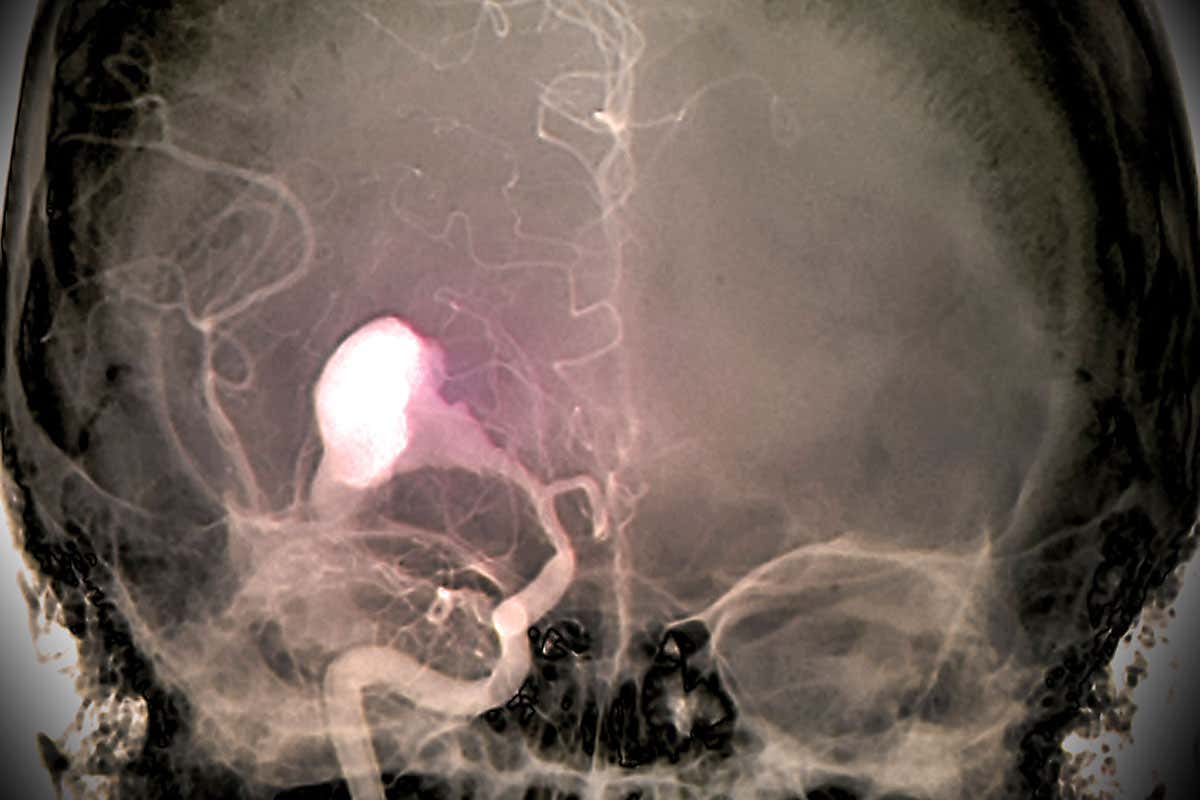 Brain haemorrhage X-ray