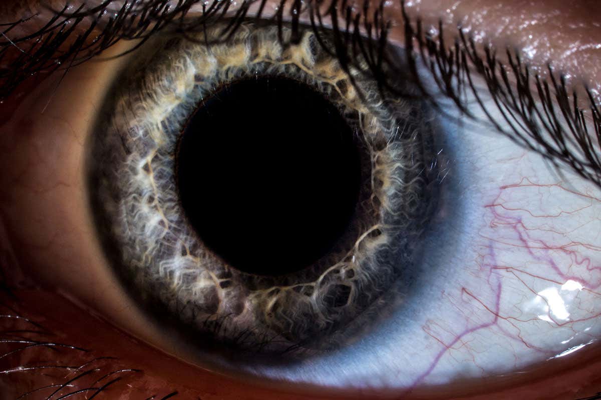 A dilated pupil