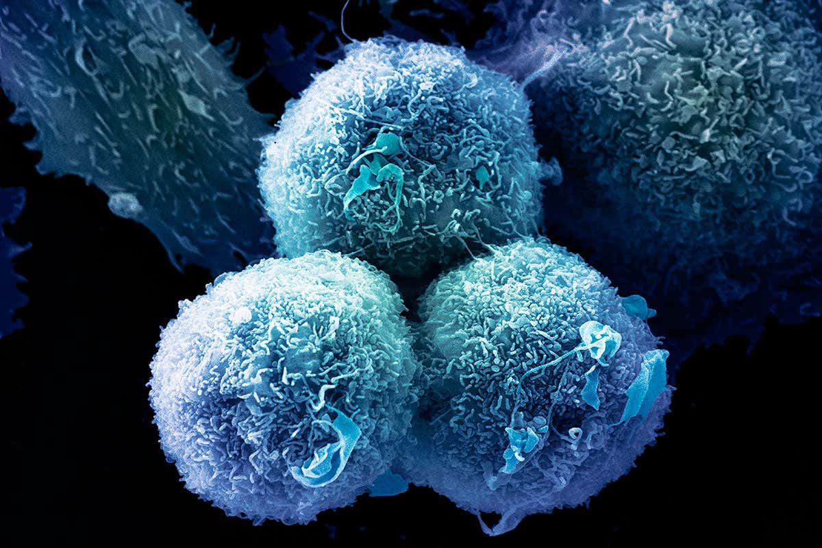Lung cancer cells, coloured scanning electron micrograph