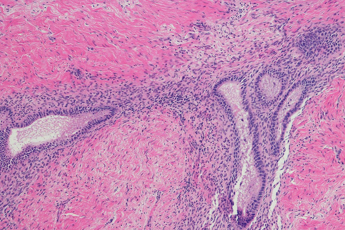 Endometrial tissue (dark purple) inside an ovary