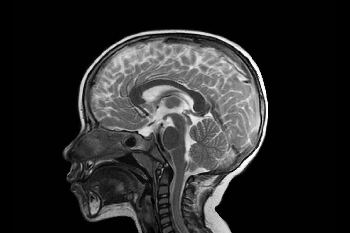 A woman with half a brain offers more proof of the organ's superpowers