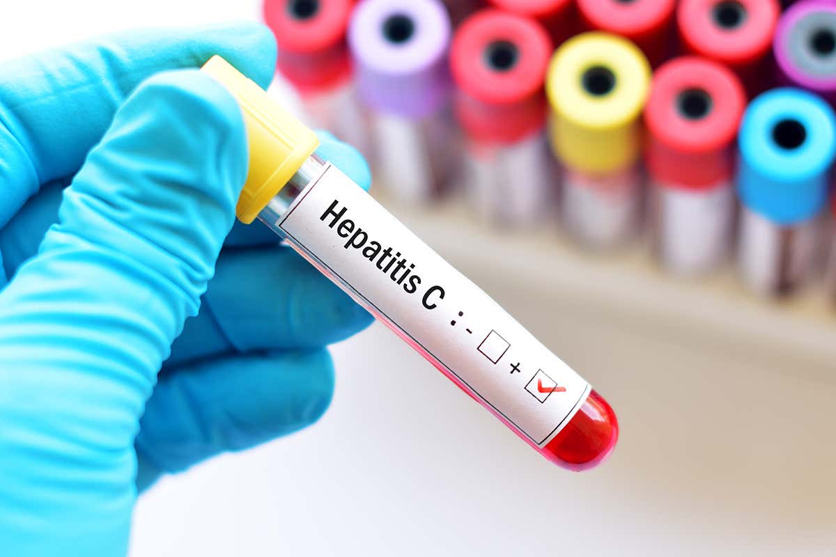 Hepatitis C infection rates are being cut by testing and treatment