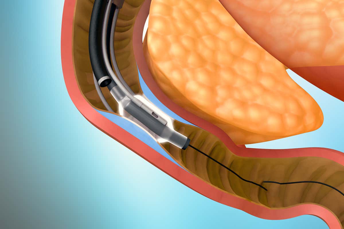 Experimental diabetes device works by killing gut cells with hot water