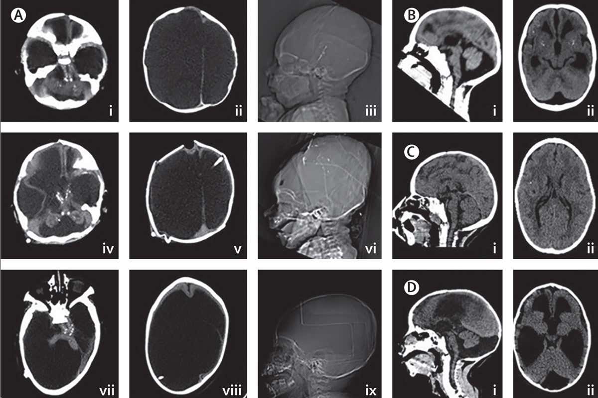 Brain scans children congenital Zika virus syndrome