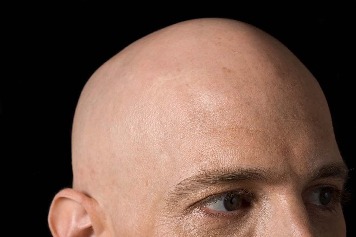 Is there an evolutionary benefit to being bald?