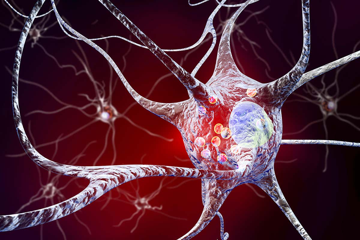 Computer illustration of human nerve cells in the brain of a patient with Parkinson's disease