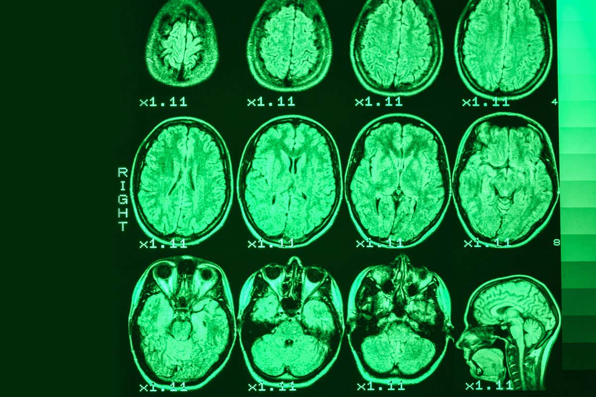 MRI of the brain of a person on a black background with green backlight
