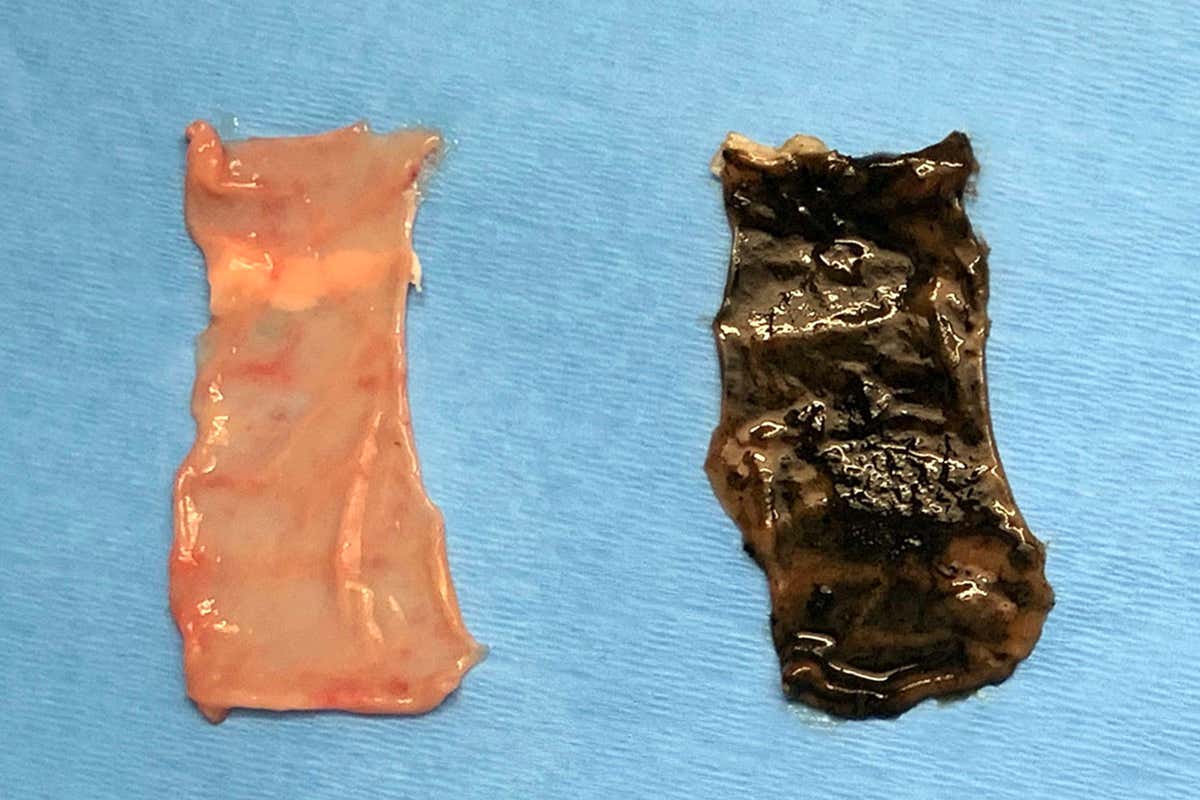 Coating our gut walls with glue could treat lactose intolerance