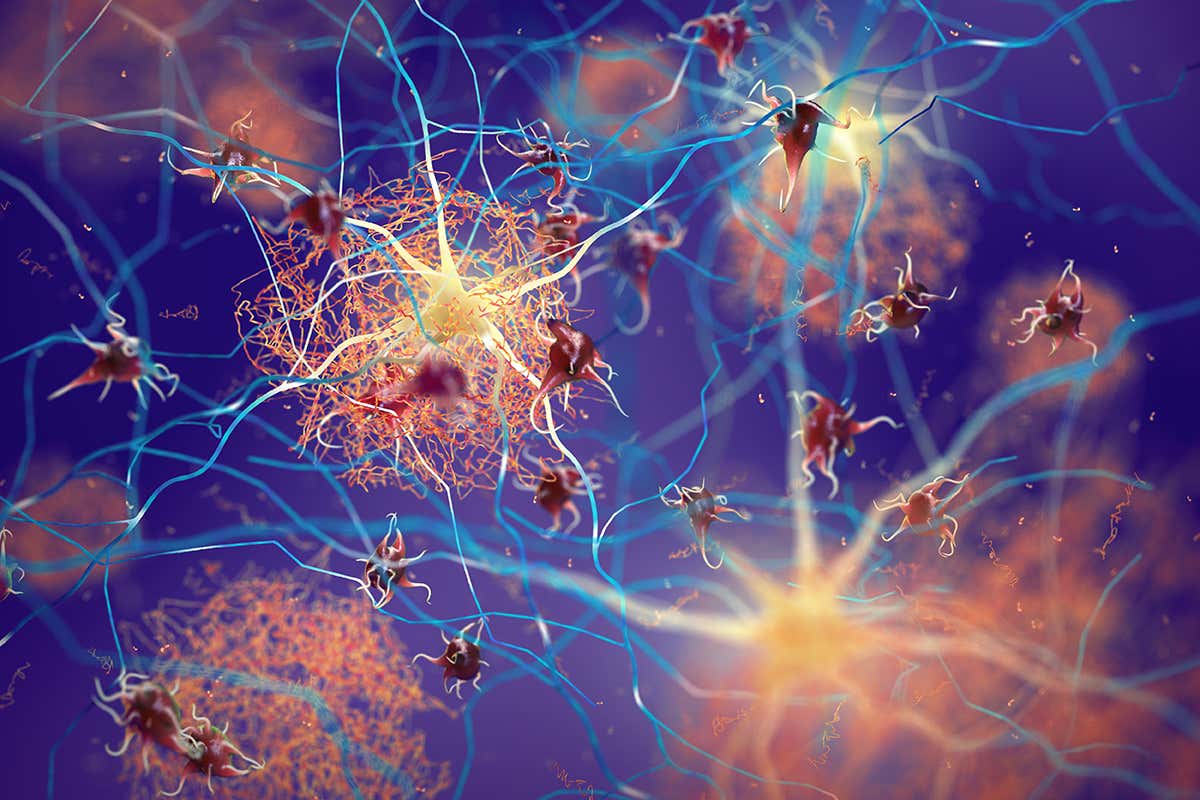 Amyloid plaques in Alzheimer's disease