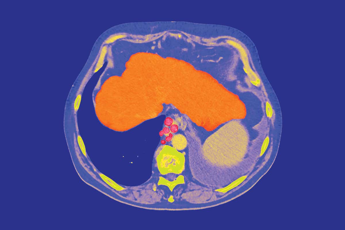 Liver scan