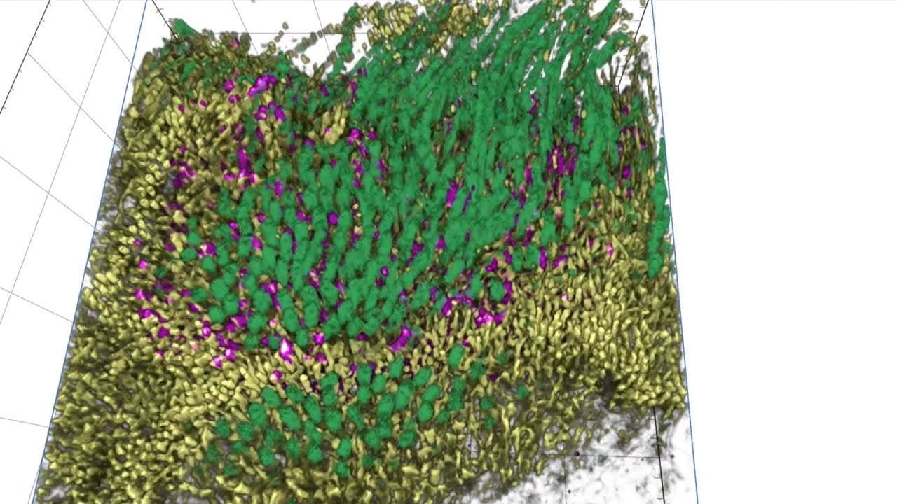 Lungs infected with covid