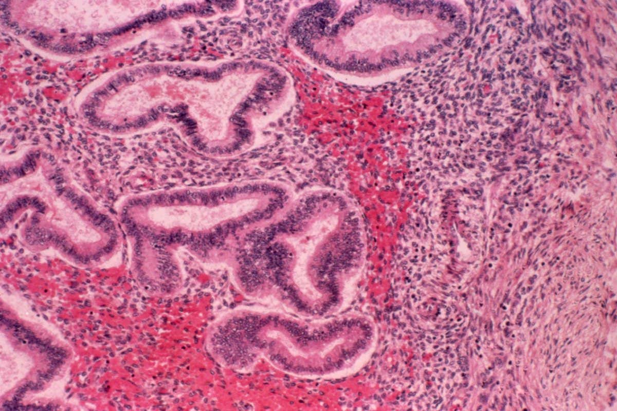 Endometriosis under a microscope