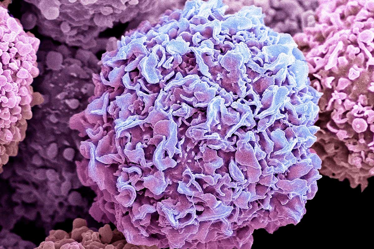 Breast cancer cells