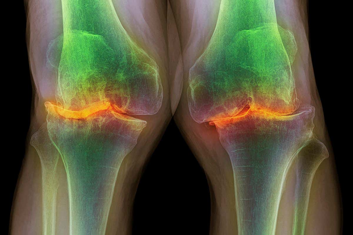 Knee osteoarthritis