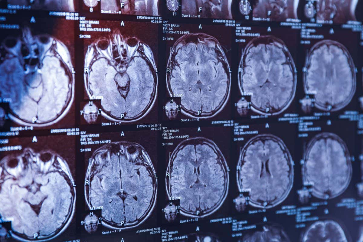 MRI scan of human head