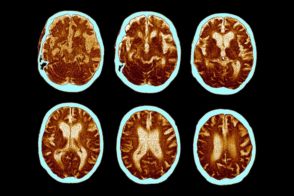Alzheimer's disease. Series of coloured computed tomography (CT) scans of an axial section through the head of a 74-year-old patient with Alzheimer's disease. The front of the brain (brown) is at the top. Alzheimer's is a neurodegenerative disease and a common cause of dementia in the elderly. It causes brain atrophy (decrease in size), shown here by the enlarged ventricle cavities (white, at centre of brain) and the widened pale blue regions. The brain shrinkage caused by Alzheimer's disease leads to memory loss, confusion, personality changes and ultimately death. The cause of Alzheimer's disease is not known and there is no cure.