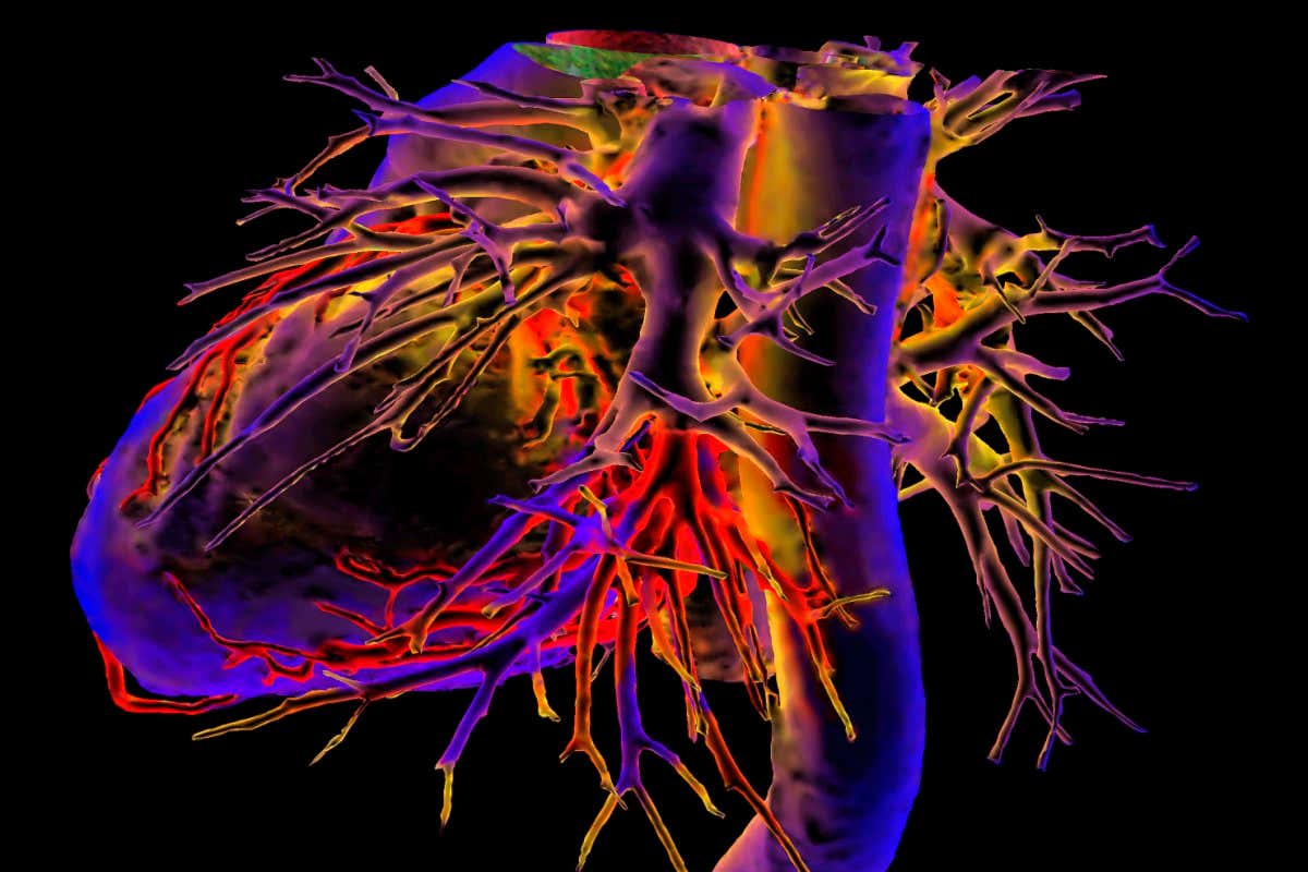 Human heart, 3D coloured computed tomography (CT) scan. This is an oblique side view. The heart is a hollow muscular organ that receives and pumps blood from and around the body through the veins and arteries that branch out from its four internal chambers. The external surface of the heart includes the coronary arteries and veins that supply blood to the heart muscle. This scan includes parts of the heart's major veins and arteries, with the aorta running down right.