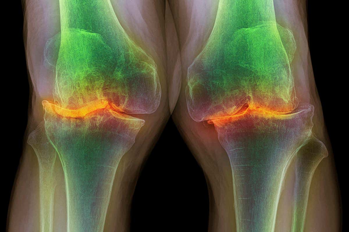 Knee osteoarthritis