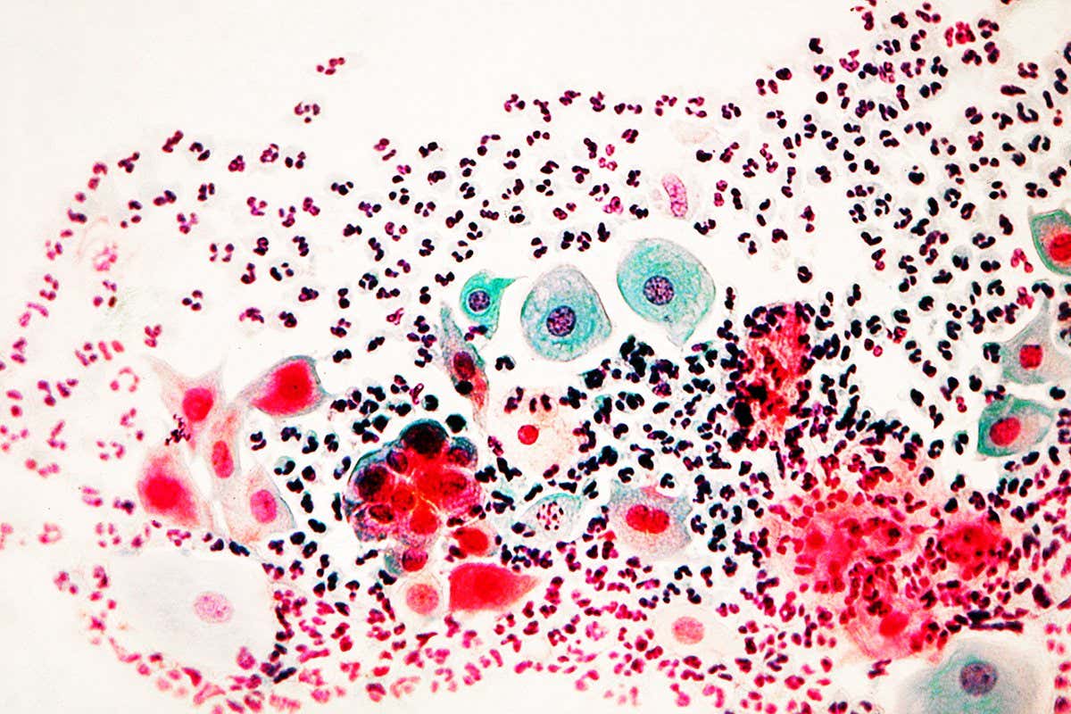 Stained micrograph of a PAP smear showing normal stellate cells. A pap smear, or pap test (after the test's inventor George Papanicolaou), is a tissue specimen from a woman's cervix that is examined for abnormalities which may indicate infection or cancer.