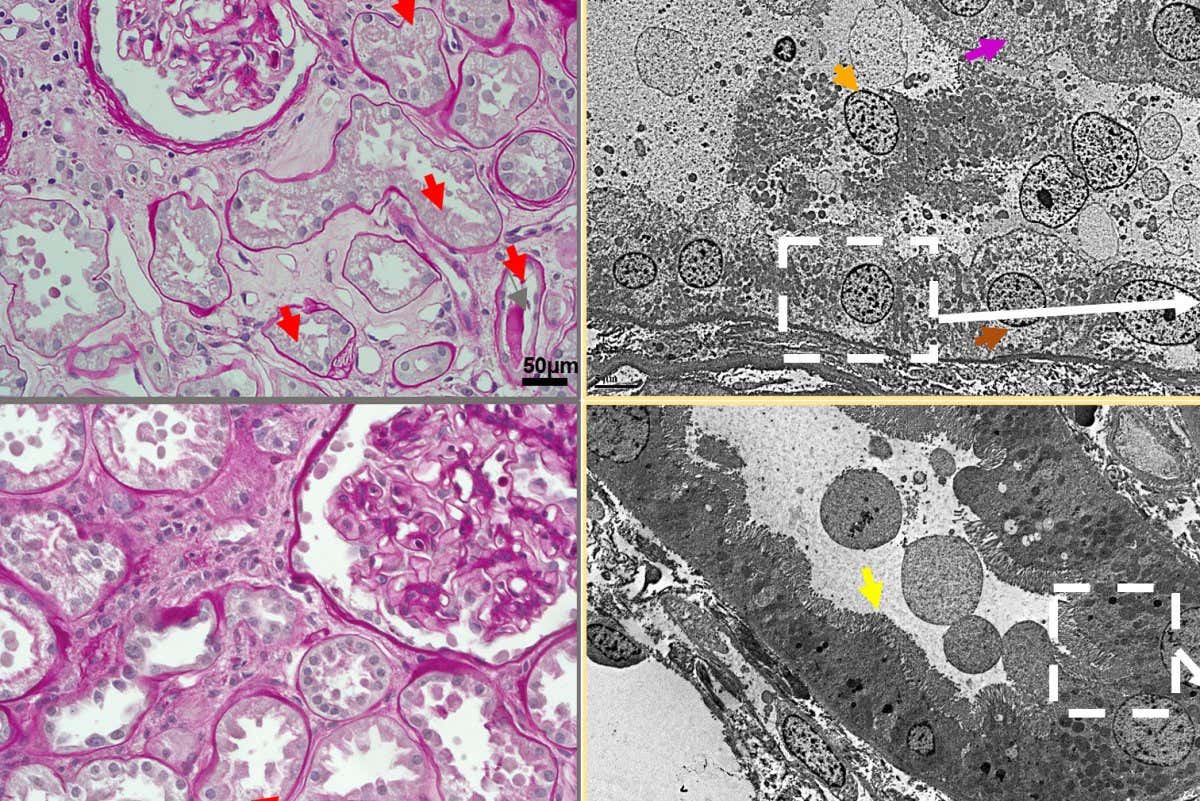 The 3rd generation synchronization modulation electric field (SMEF) technique protected human donor kidneys from tubule injury (red arrows) and other microscopic signs of damage during cold storage.