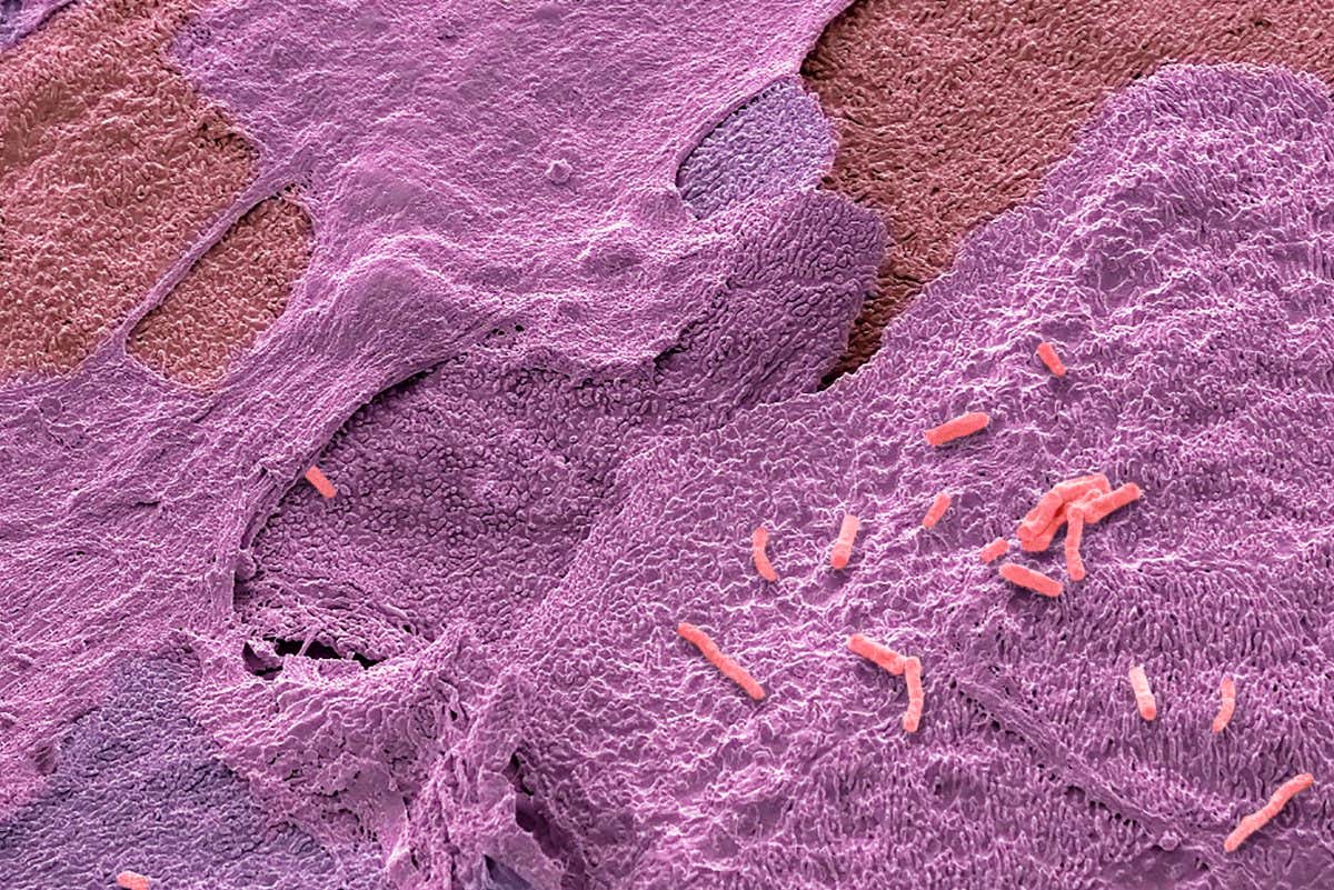 A coloured scanning electron micrograph of Escherichia coli (E. coli) bacteria on bladder cells in a urine sample from a patient with a urinary tract infection