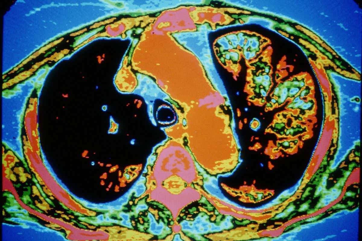 Diseased lung scan