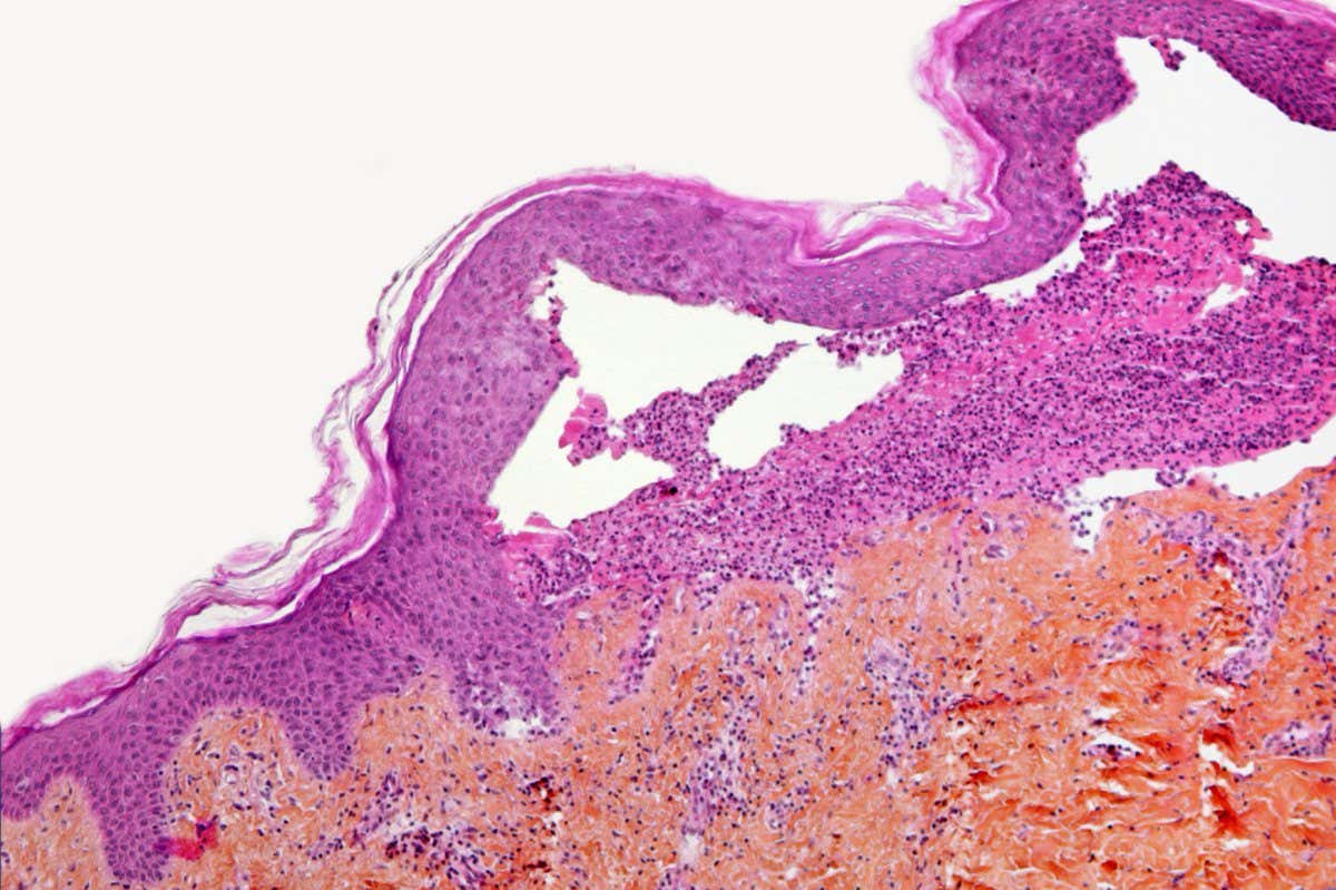 Light micrograph section through the skin of a patient with epidermolysis bullosa (EB) showing cleavage of part of the epidermis. EB is a rare genetic disease of the connective tissues in the skin and mucosal membranes. In this condition, no collagen forms between the skin layers (the dermis and epidermis). This allows them to move across each other at the slightest pressure, resulting in blisters and painful sores. Hematoxylin and eosin stain. Magnification: x550 when printed at 10 centimetres wide.