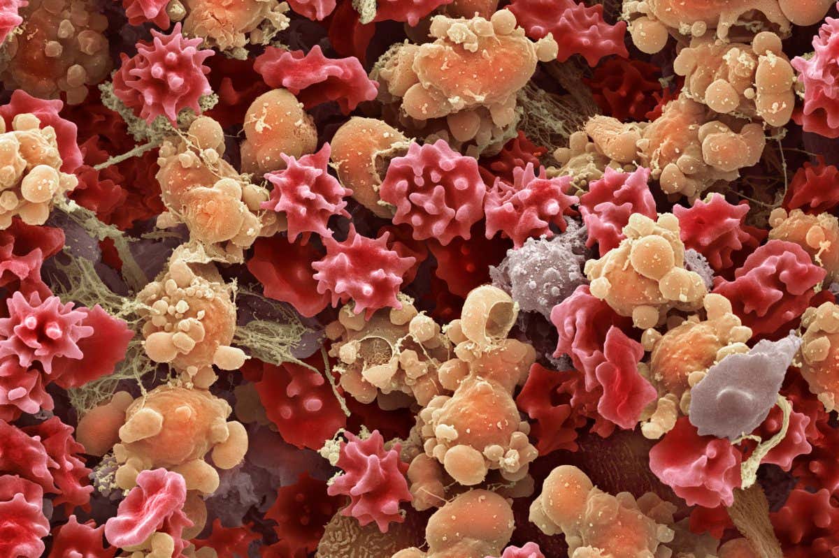 Cells from a urine infection