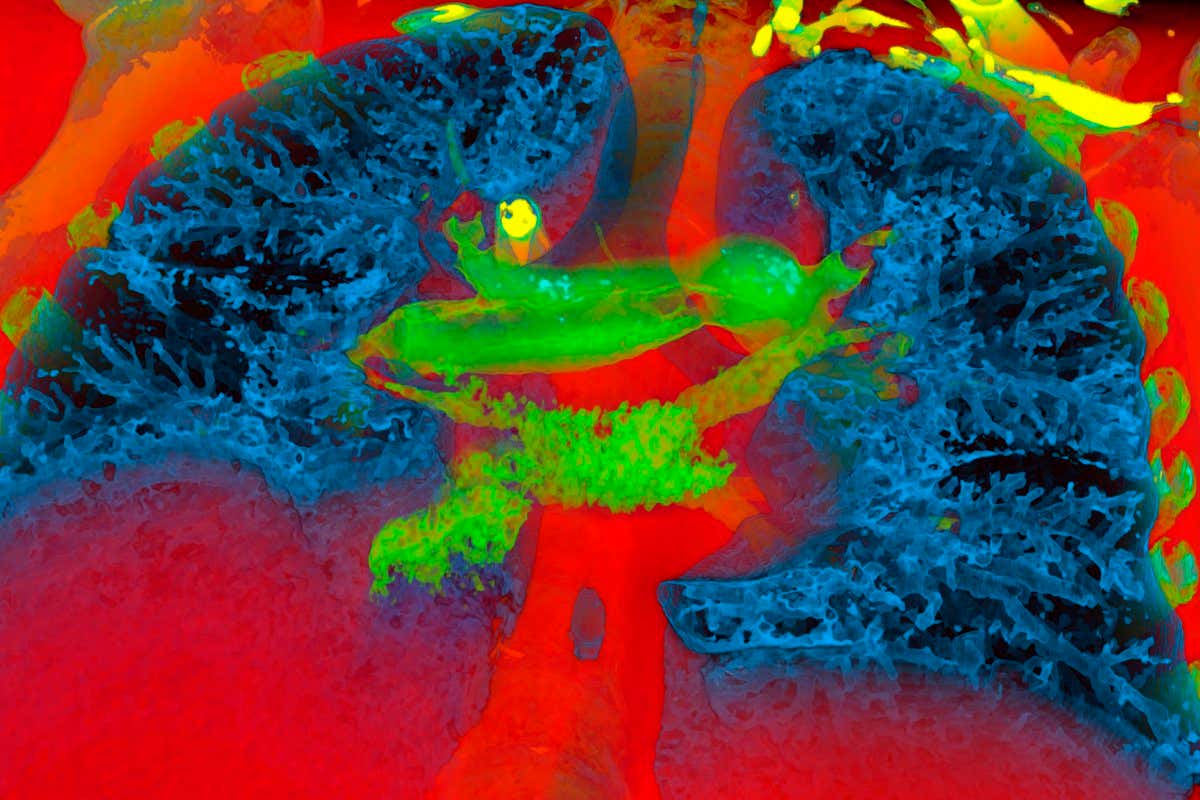 A coloured 3D CT scan of a pulmonary embolism