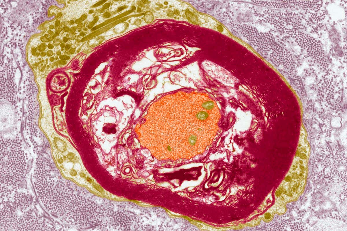 Nerve demyelination. Coloured transmission electron micrograph (TEM) of a section through a Schwann cell and a nerve fibre, showing the early collapse of its myelin sheath. Myelin (red) is an insulating fatty layer that surrounds the nerve fibre (axon, orange), increasing the speed at which nerve impulses travel. It is formed when a Schwann cell (green) wraps around the fibre, depositing layers of myelin between each coil. Demyelination occurs in nerve disorders such as multiple sclerosis (MS). Patches (lesions) of myelin sheath are destroyed and nerve function is impaired. Magnification: x3800 when printed 10 centimetres wide.