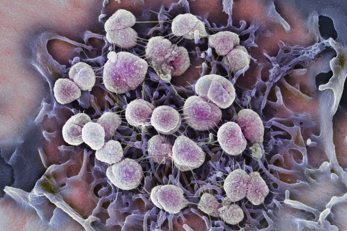 Gonorrhoea bacteria. Coloured scanning electron micrograph (SEM) of Neisseria gonorrhoeae bacteria (round) on the surface of a cell. N. gonorrhoeae is a Gram-negative bacteria that causes the sexually transmitted infection gonorrhoea. Symptoms include vaginal or urethral discharge and a burning sensation on urination.