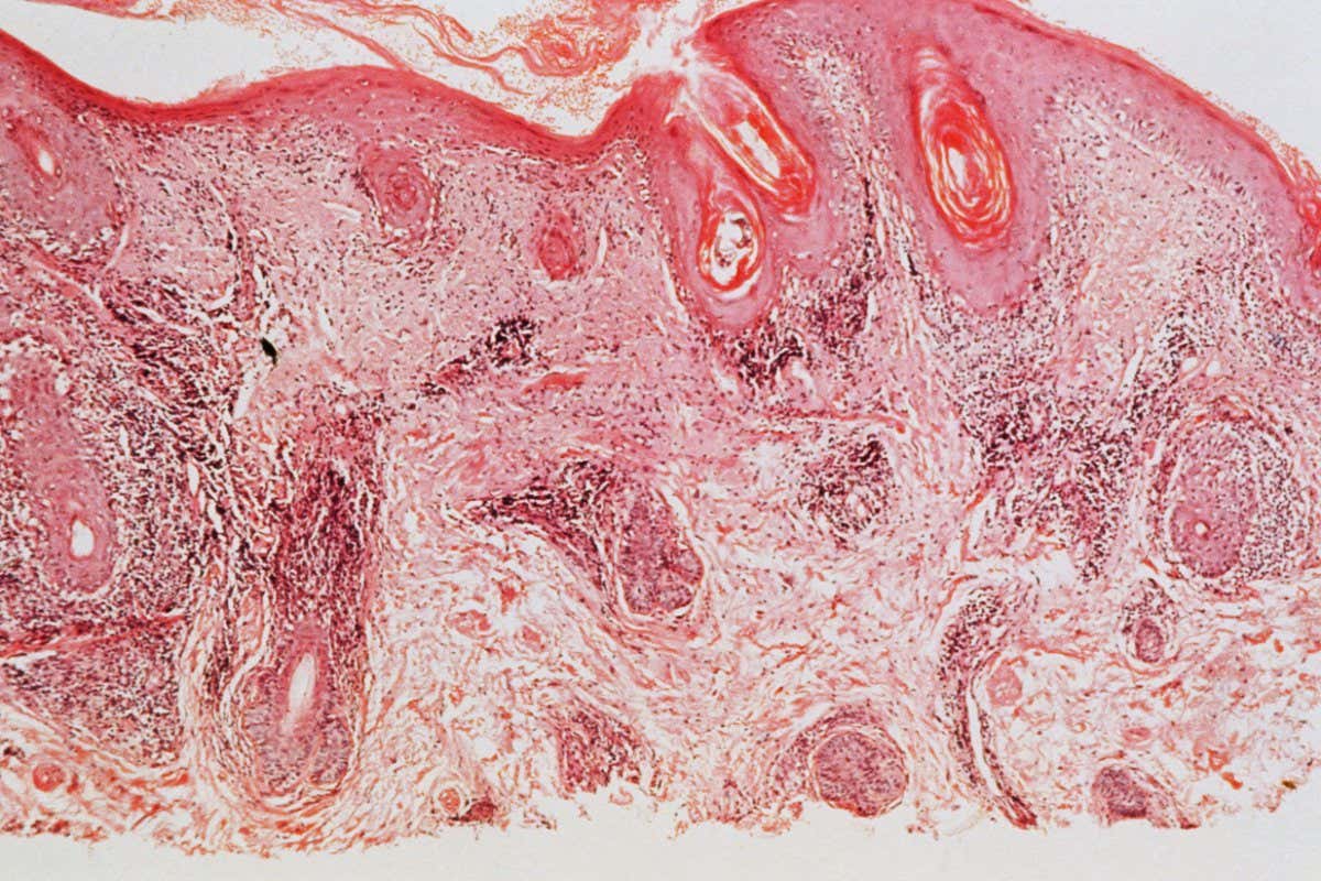 A light micrograph of plaques in someone with lupus