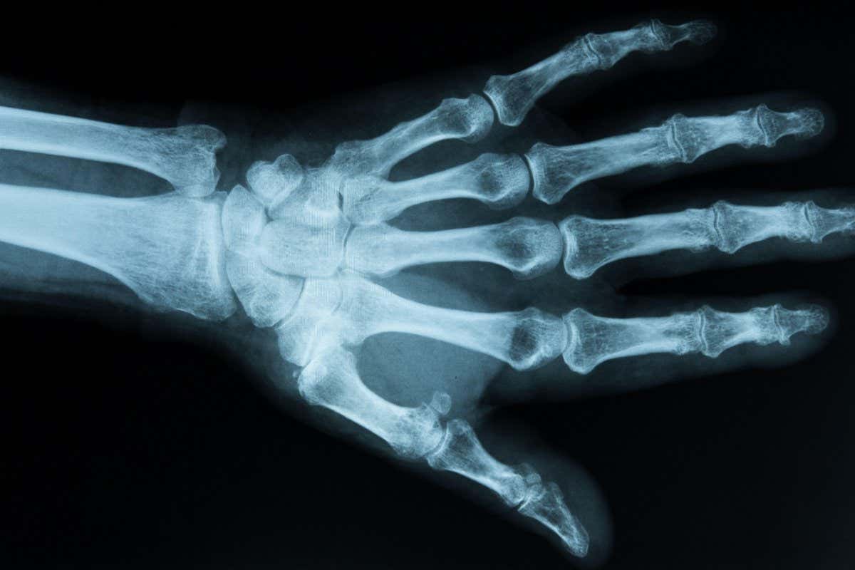 2B1076K xray scan of hand