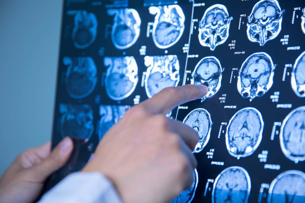 A stock image of a medic assessing an MRI brain scan