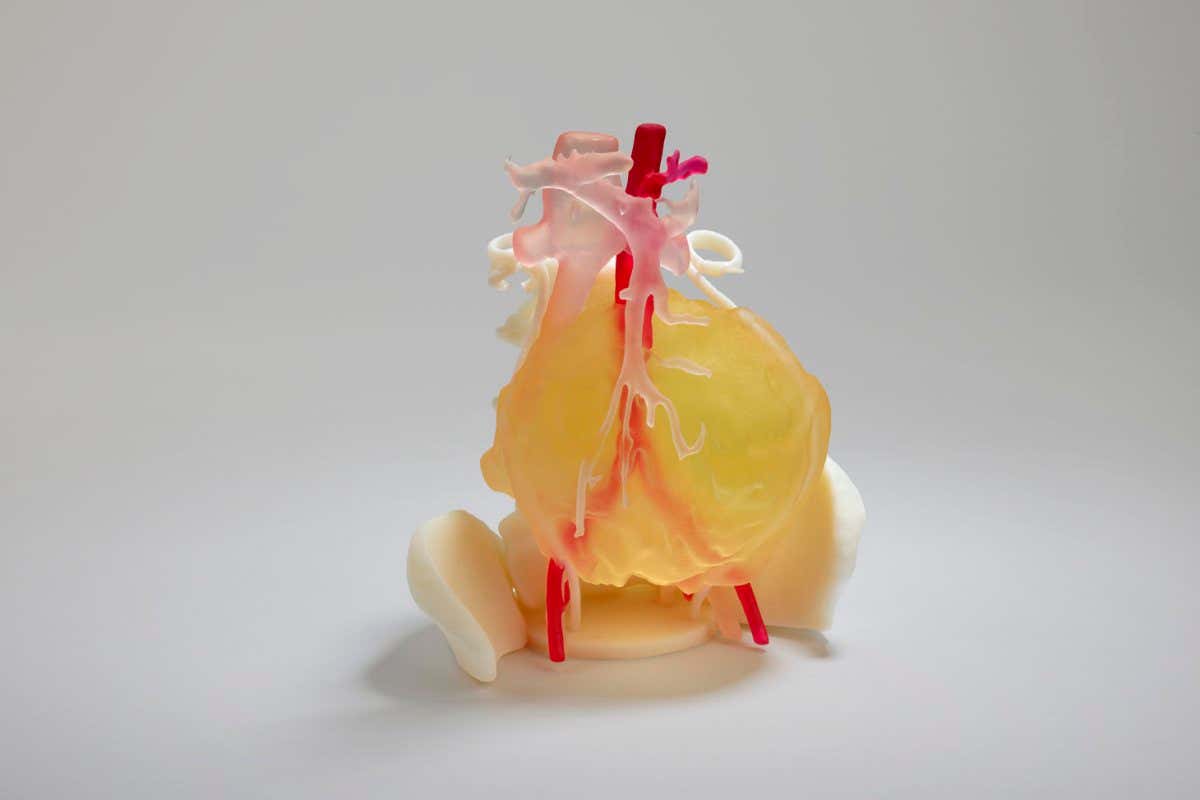 3D printed anatomical model of tumour of Leah Bennet, made for surgeons at Alder Hey Hospital, made by 3D LifePrints, 2021.