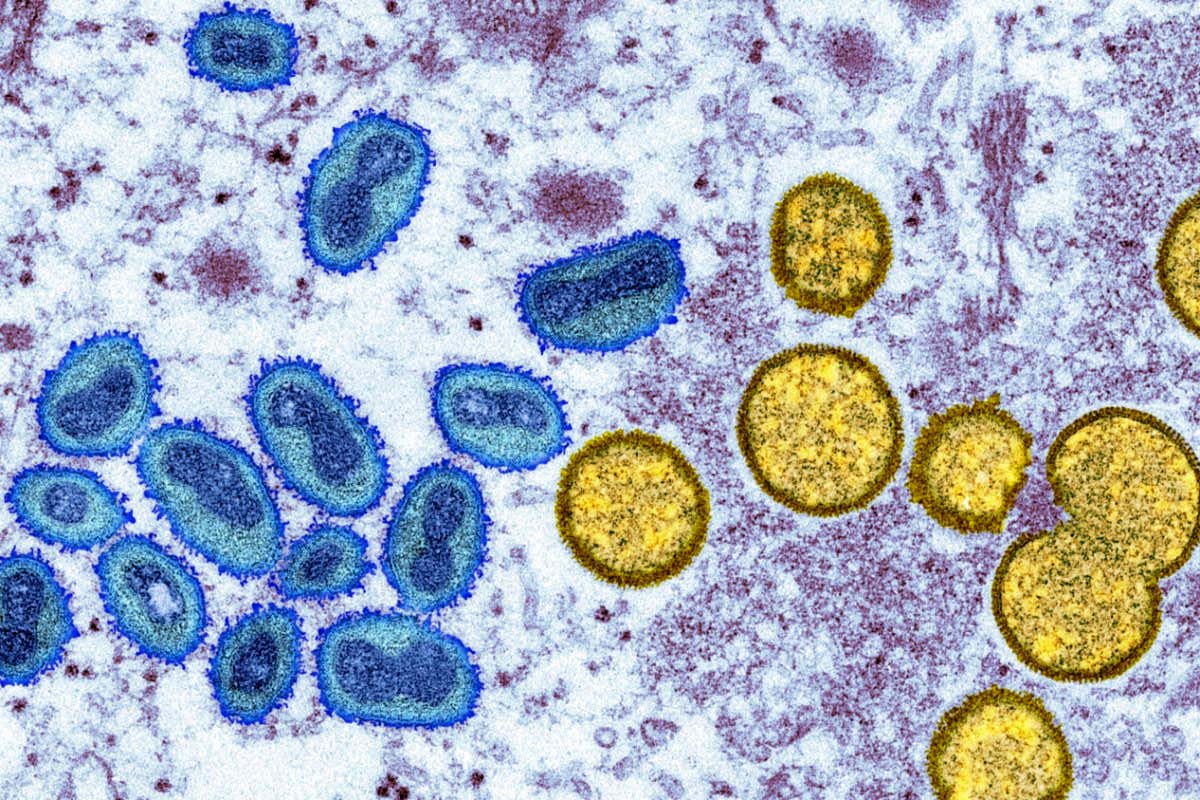 Monkeypox virus particles taken from a human skin sample, captured via a coloured transmission electron micrograph