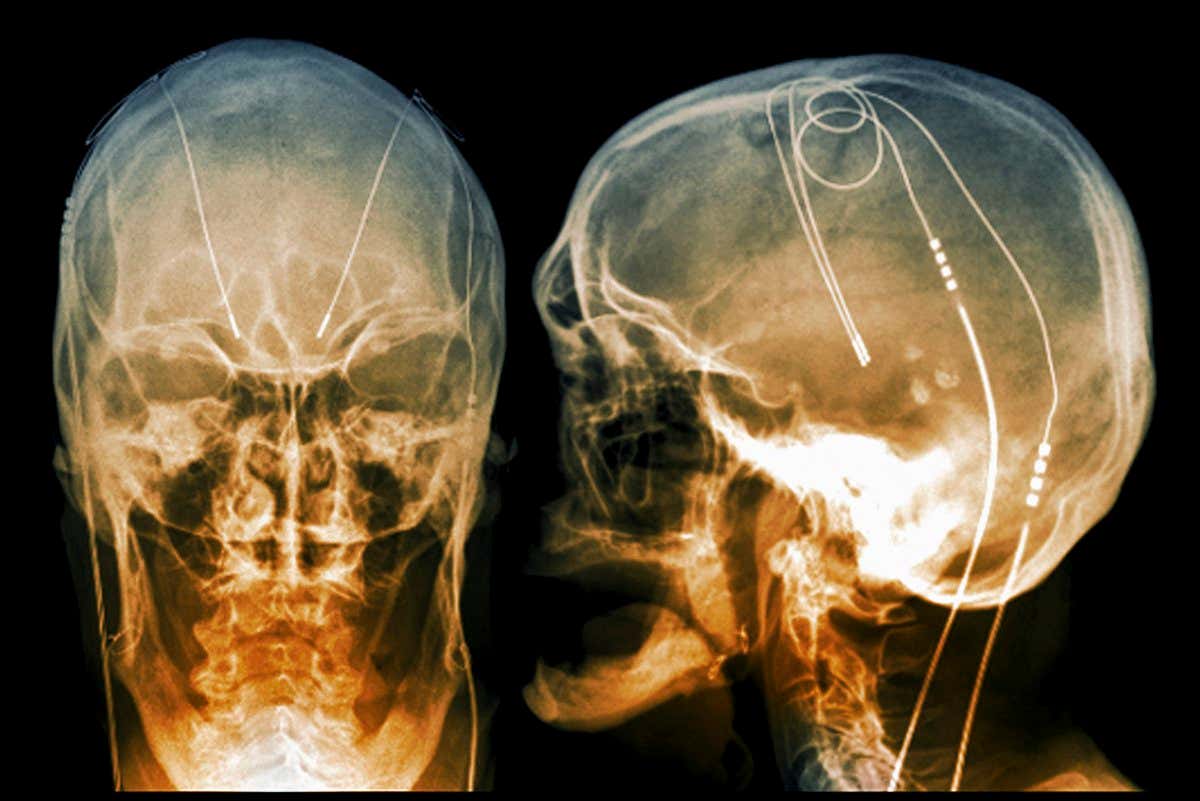 Coloured X-rays showing the electrodes of a deep brain stimulator implanted in a person with Parkinson's disease