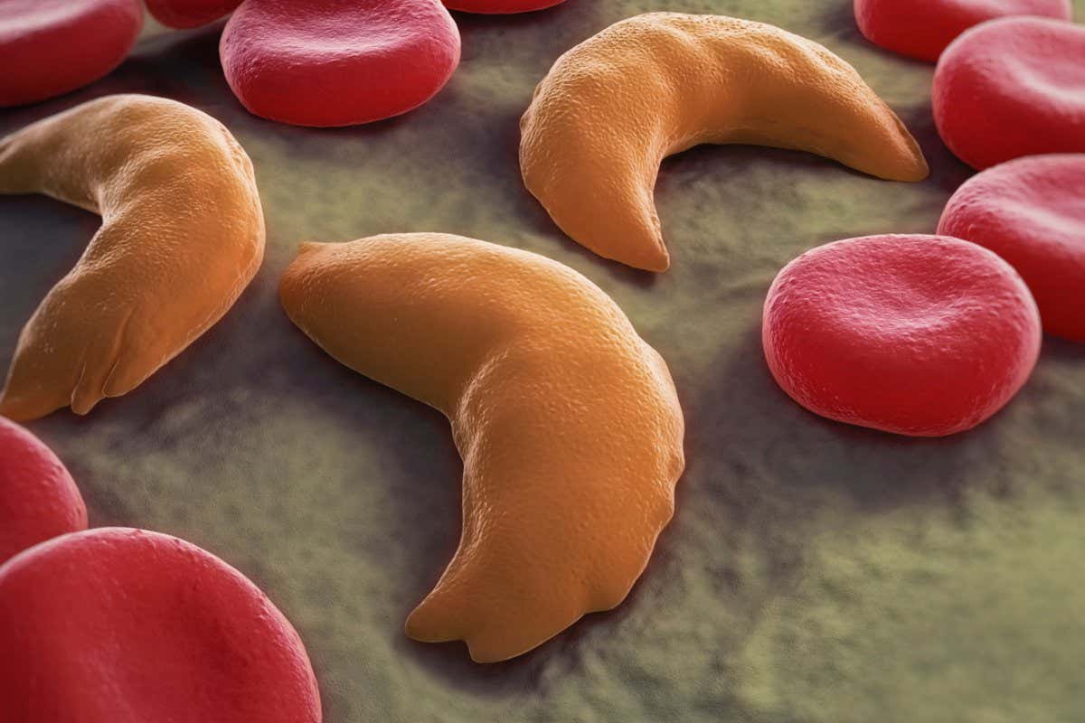 Sickle-cell disease is a recessive genetic blood disorder that affects red blood cells
