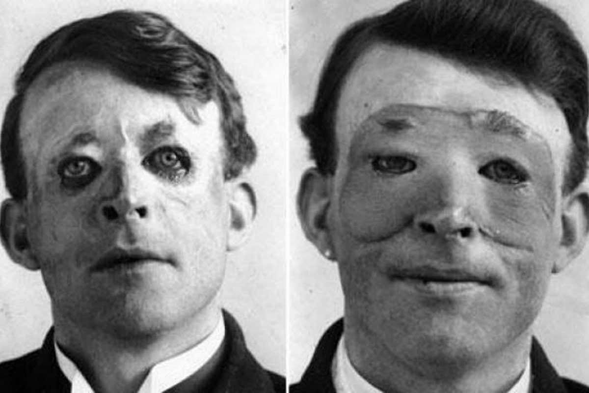 HRNPF3 Walter Yeo, one of Gillies? patients, before and after reconstructive surgery. WWI Plastic Surgery Patient