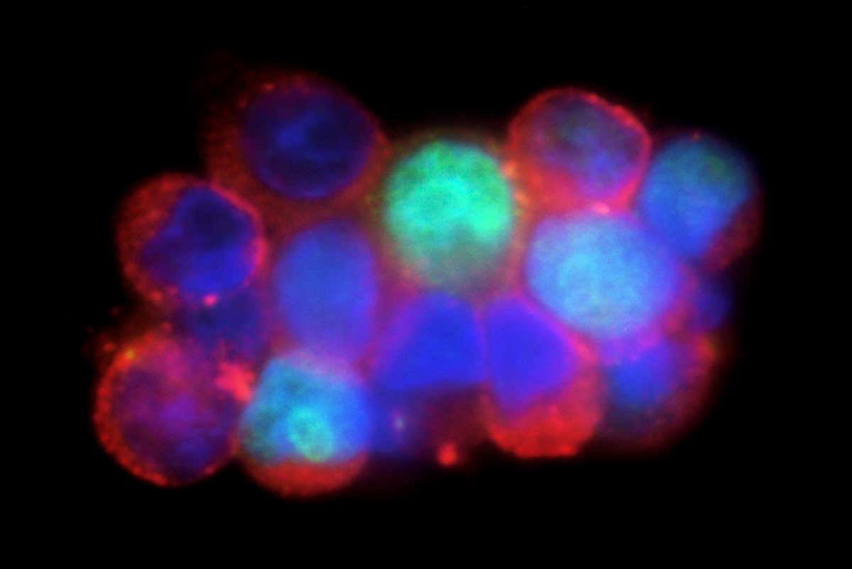Circulating breast cancer cells. Fluorescence light micrograph of a cluster of circulating tumour cells (CTCs, red) and white blood cells (green) from the blood of a patient with breast cancer. CTCs are an important focus of cancer research because they provide a key target for new treatments. By identifying the molecular adaptations and genetic mutations that allow CTCs to spread (metastasize), it may be possible to develop strategies to block metastatic cancer on a patient-by-patient basis.